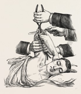 excision of the elbow, sawing of the humerus, medical equipment, surgical instrument, history of