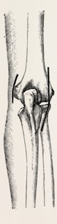 excision the elbow is now extended, medical equipment, surgical instrument, history of medicine