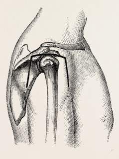 excision, medical equipment, surgical instrument, history of medicine