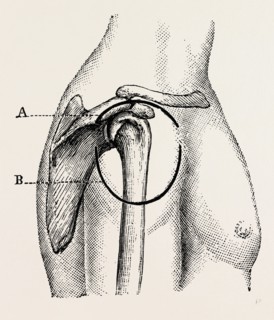 excision of the shoulder, medical equipment, surgical instrument, history of medicine