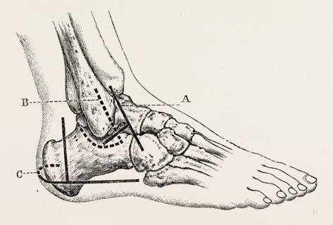 excision of astragalus, outer incision, medical equipment, surgical instrument, history of medicine