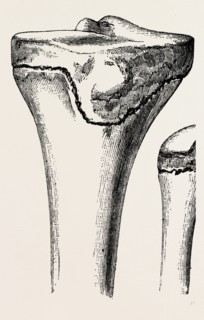 epiphyses of the femur, medical equipment, surgical instrument, history of medicine