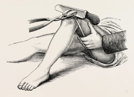excision of the knee, the sawing of the lower end, medical equipment, surgical instrument, history