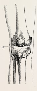 excision, medical equipment, surgical instrument, history of medicine