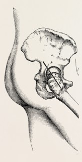 excision of the hip, medical equipment, surgical instrument, history of medicine
