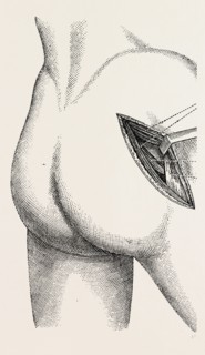 excision of the hip by an external incision, medical equipment, surgical instrument, history of