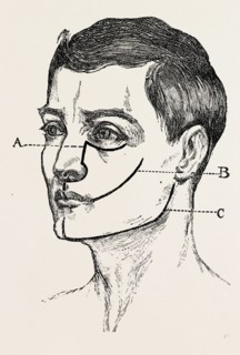 excision, medical equipment, surgical instrument, history of medicine