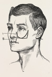 excision of the tipper jaw, medical equipment, surgical instrument, history of medicine