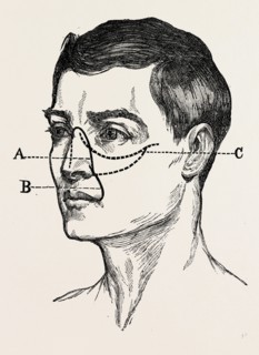 operations for naso-pharyngral, medical equipment, surgical instrument, history of medicine