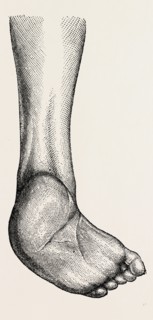 incurved form of the foot, the planzar, medical equipment, surgical instrument, history of medicine