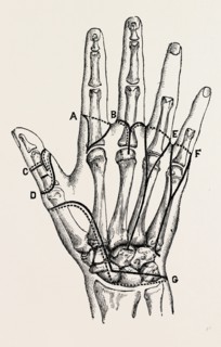 disarticulation, medical equipment, surgical instrument, history of medicine