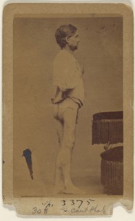 Hugh Wright Civil War victim; Attributed to William H. Bell, American, 1830 - 1910, about 1865; Albumen silver print