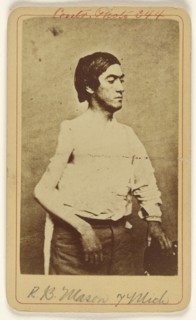 R.B. Mason Pvt. 7 Mich. Excis. head of humerous. Civil War victim; Baldwin & Prior, American, 1865 - 1867, about 1865; Albumen