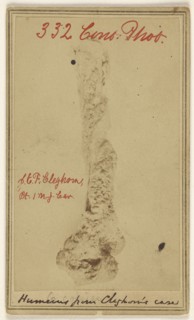 Necrosis of humerus removed Entire with elbow joint by James B. Cutter M.D. Newark, N.J. Patient John E.F. Cleghorn 1st N.J.Cav