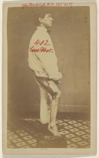 No. 2. Case of John Frederick U.S.N. Side View; Attributed to William H. Bell, American, 1830 - 1910, about 1864; Albumen