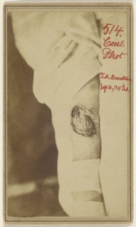 Leg wound of Thomas M. Armstrong, Civil War victim; American; November 2, 1864; Albumen silver print