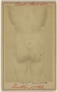Jno. E. Tucker, shot in the buttocks, Civil War victim; American; 1865 - 1870; Albumen silver print