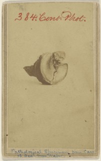 Pathological Specimen from case of Genl. Max Weber. Civil War victim; American; 1862 - 1864; Albumen silver print