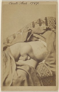 Diseased undescended Testes with Hydwelle; American; 1862 - 1872; Albumen silver print