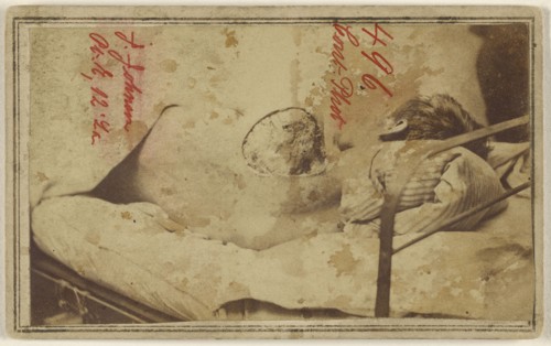 Joseph Johnson, Civil War victim; American; 1864 - 1865; Albumen silver print