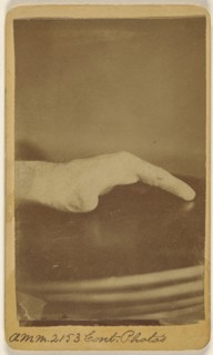 Right hand of Saml. Hagle, wounded at Petersburg June 17th 1864; H.D. Ward, American, active North Adams, Massachusetts 1860s