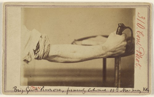 Excision of radius of Brig. Genl. Penrose, formerly Colonel 15th New Jersey Vols; Kennedy & Schenck; about 1865; Albumen silver