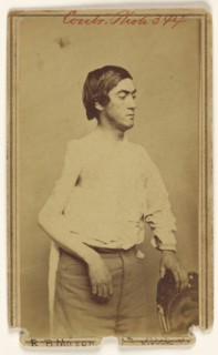 Russell B. Mason, Civil War victim; Baldwin & Prior, American, 1865 - 1867, about 1864; Albumen silver print