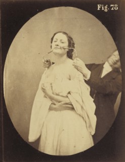 Electro-physiologie Photographique, Fig. 78; Guillaume-Benjamin Duchenne, French, 1806 - 1875, 1876; Albumen silver print
