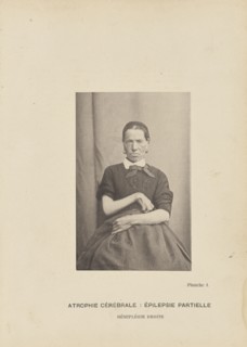 Atrophie Cérébrale: Épilepsie Partielle Hémiplégie Droite; Paul-Marie-Léon Regnard, French, 1850 - 1927, Paris, France; 1878