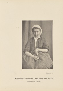 Atrophie Cérébrale: Épilepsie Partielle Hémiplégie Gauche; Paul-Marie-Léon Regnard, French, 1850 - 1927, Paris, France; 1878