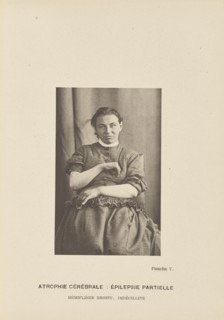 Atrophie Cérébrale: Épilepsie Partielle Hémiplégie Droite; Imbécillité; Paul-Marie-Léon Regnard, French, 1850 - 1927, Paris