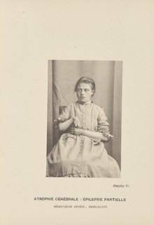 Atrophie Cérébrale: Épilepsie Partielle Hémiplégie Droite; Imbécillité; Paul-Marie-Léon Regnard, French, 1850 - 1927, Paris