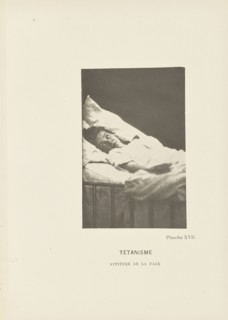 Tétanisme Attitude de la Face; Paul-Marie-Léon Regnard, French, 1850 - 1927, Paris, France; 1878; Photogravure; 10 × 6.5 cm