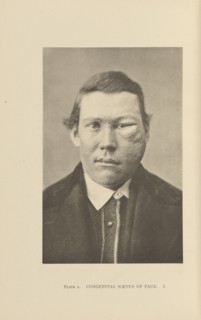 Congenital Nævus of Face; Charles B. Brigham, American, 1845 - 1903, Cambridge, Massachusetts, United States; 1876; Heliotype