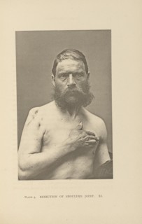 Resection of Shoulder Joint; Charles B. Brigham, American, 1845 - 1903, Cambridge, Massachusetts, United States; 1876