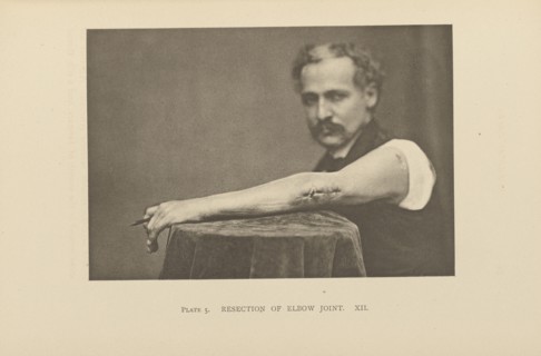 Resection of Elbow Joint; Charles B. Brigham, American, 1845 - 1903, Cambridge, Massachusetts, United States; 1876; Heliotype
