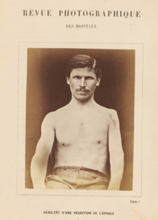 Result d'une résection de l'épaule, Portrait of an unknown man after a shoulder resection,