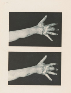 Two views of an arm with symptoms of skin lupus, page, photomechanical print, stereograph,