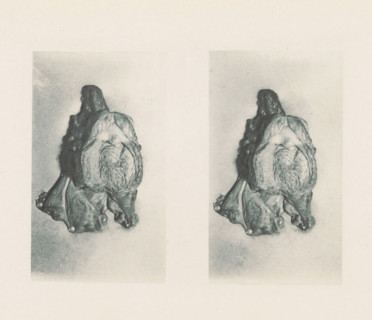 Two views of a prostate with hypertrophy of the lobes, page, photomechanical print, stereograph,