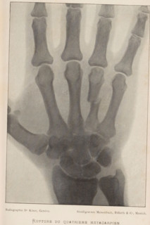 Rupture du Quatrième Métacarpien, X-ray of a hand with a broken metacarpal, page, photomechanical