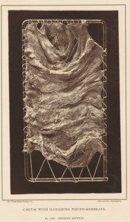 Caecum with Sloughing Pseudo-Membrane, page, photomechanical print, address: '1002 Arch St.,