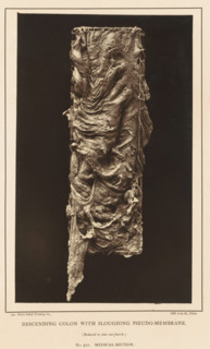Descending Colon with Sloughing Pseudo-Membrane, page, photomechanical print, address: '1002 Arch