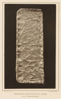 Descending Colon with Oval Ulcers, page, photomechanical print, number: 'No. 136. MEDICAL SECTION