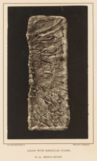 Strained section of colon with irregular ulcers, Colon with Irregular UICers, page, photomechanical