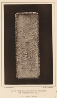 Ileum with Enlarged Solitary Follicles and Hypertrophied Villi, page, photomechanical print,