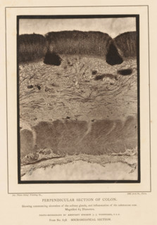 Perpendicular Section of Colon, Enlargement of the formation of ulcers in cavities in a piece of