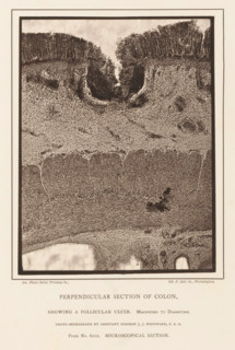 Enlargement of a distended cavity in a piece of large intestine, Perpendicular Section of Colon,