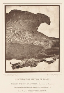 Perpendicular Section of Colon, through the Edge of an Ulcer, Enlargement of the edge of an ulcer