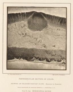 Enlargement of a swollen gland in a piece of large intestine, Perpendicular Section of Colon
