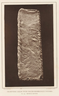 Transverse Colon with Pseudo-Membranous Patches, Stretched section of transverse intestine with
